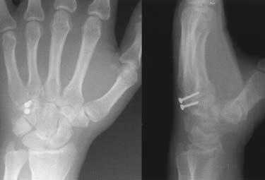 (C) After open reduction and internal fixation with miniscrew for hamate, percutaneous K-wires pinng for metacarpal base was done.