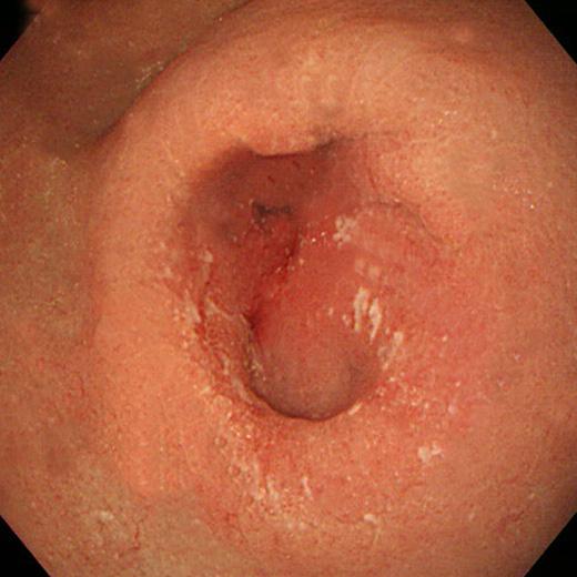 (A) Chronic duodenal ulcer with pyloric stenosis is found, and the scope can not be passed beyond the pyloric ring.