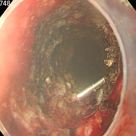 (C) Using two working channel therapeutic endoscopy, the most proximal part of the exposed stent