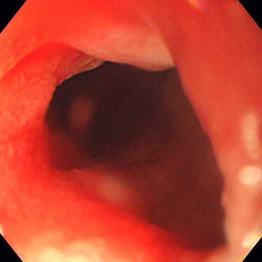 removed outside the gastrointestinal tract. Figure 4. Endoscopic findings.