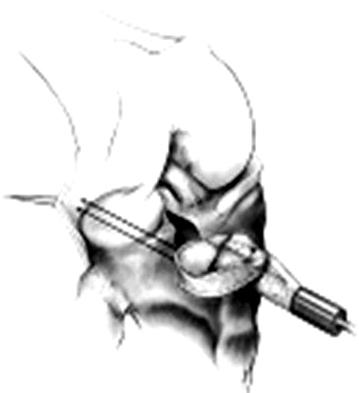 0 년 ) 이었다. 내측반월상연골은경골극과전방십자인대의손상을방지하기위하여전후방골편 (bone plugs) 을이용한고정을사용하였고 (Fig.