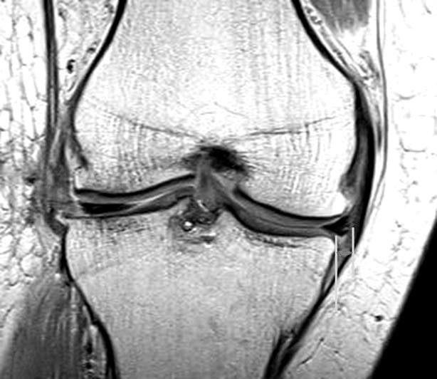 38 edge of the meniscus) 까지의거리로정의하였고 7), 3 mm 이상아탈구된경우를변연탈구 (extrusion) 로정의하였다 4). 측정방법은 Verdonk 등 31) 이제시한방법을이용하였다 (Fig. 4). 첫이식술후재활치료는첫 4주는목발착용한상태에서 20% 의체중부하만허용하고, CPM ( 지속성수동적운 Table 1.