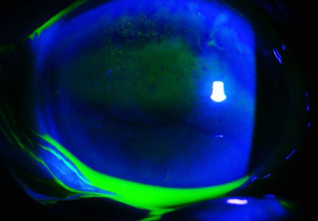 () Increased corneal epithelial defects in the fluorescein