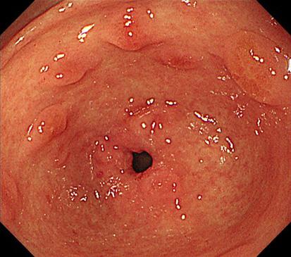 X: not observed, : sometimes observed. LC, lesser curvature. Adapted from the book of Haruma, et al. Kyoto classification of gastritis.