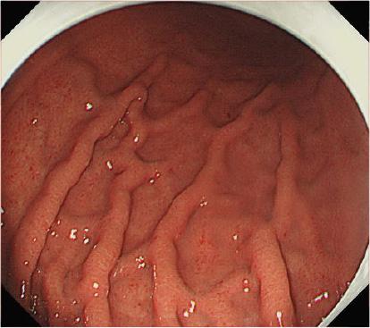 (intestinal metaplasia, IM), 백탁점액 (sticky mucus),