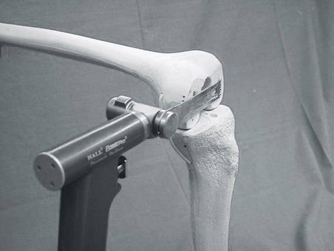 lateral condyle of the femur was resected with a freehand technique.