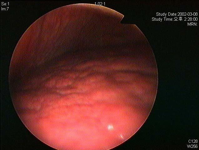- 대한내과학회지 : 제 75 권부록 3 호 2008 - A B Figure 1. (A) Peritoneoscopic findings: The liver has a nodular surface.
