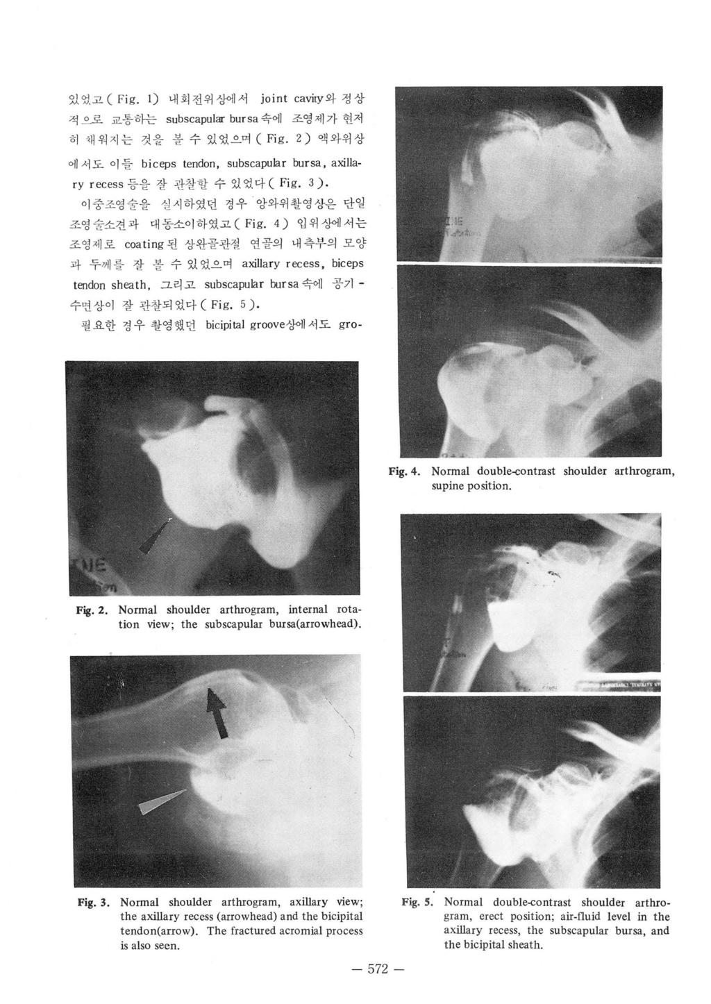 있었고 (F i g. 1) 내회전위잉에서 jo i n t caviry 와정상적으로교통하는 subscapular bur sa 속에조영제가현저히채워지는것을볼수있었으며 (Fig. 2) 액와위상에서도이들 biceps tendon, subscapular bursa, axillary recess 등을잘관찰할수있었다 ( Fi g. 3).