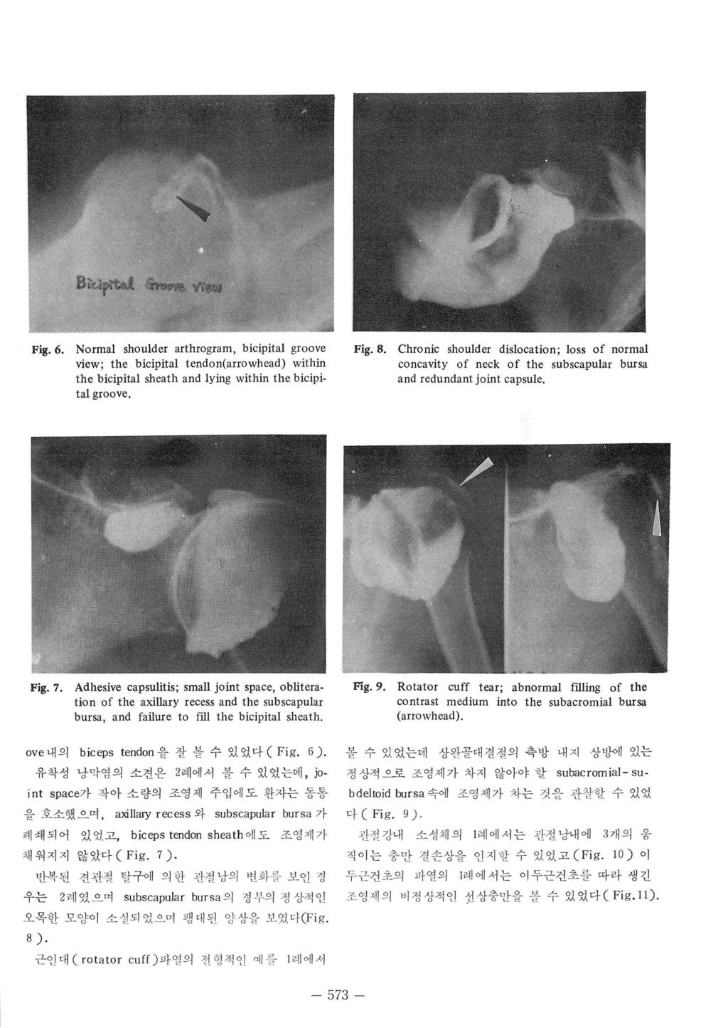 Fig. 6. Normal shoulder arthrogram, bicipital groove view; the bicipital tendon(arrowhead) within the bicipital sheath and lying within the bicipital groove. Fig. 8.