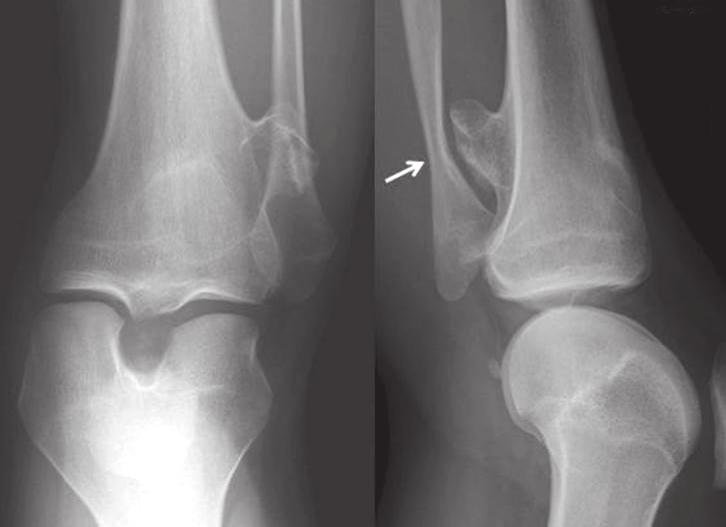 Magnetic resonance imaging (MRI) 영상검사는통증의원인을찾는데도움이된다. 통증의원인으로는종양주위점액낭형성, 악성화, 신경혈관다발의압박, 골절등이있다.