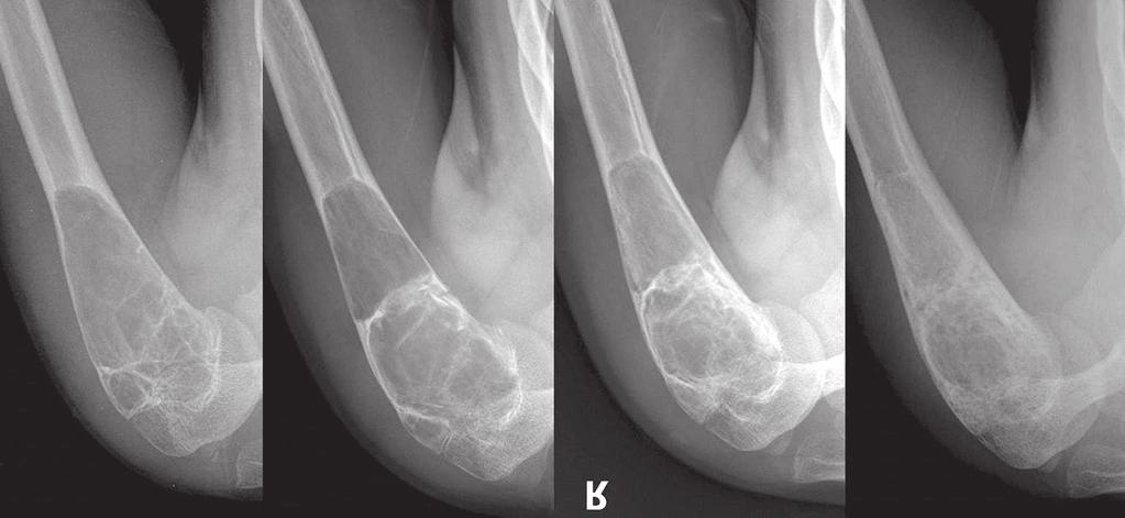 6) 저등급골내골육종 (low-grade central osteosarcoma) 의많은수가초기에섬유성이형성증으로오진된경우가많다는보고가있어주의를요한다.