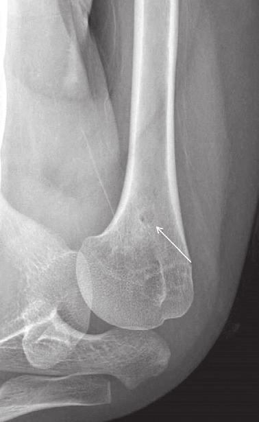 416 조환성 박영균 오주한외 2 인 C Figure 13. () n osteoid osteoma in the proximal humerus showing lack of sclerosis around the lesion (arrow).