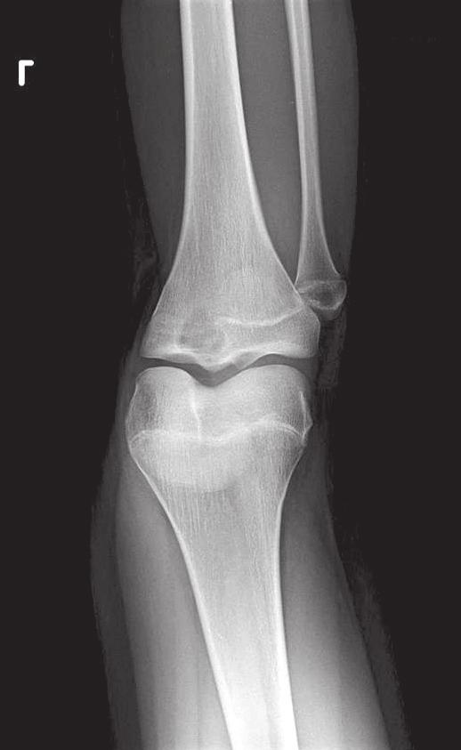 417 C Figure 15. () chondroblastoma in the proximal tibial epiphysis.