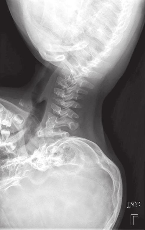 419 C Figure 20. () Langerhans cell histiocytosis involving the skull. () plain radiograph of Langerhans cell histiocytosis in the distal humerus of a 15-year-old boy. (C) Vertebra plana.