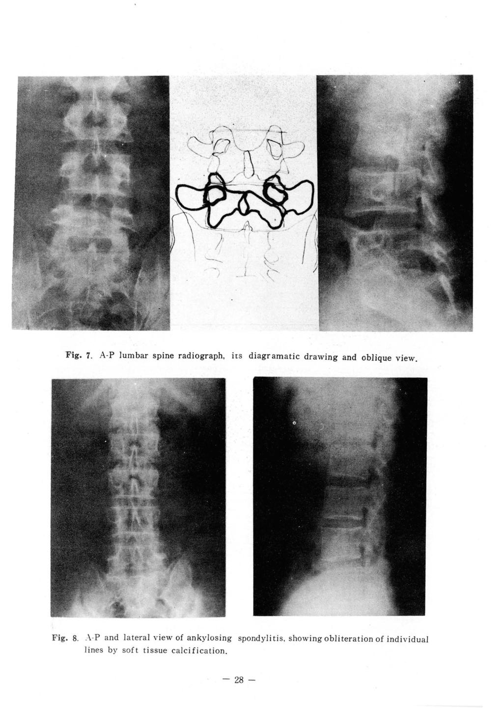 , J-- 7. A.P lumbar spine radiograph, its diagr \Fig. amatic drawing and oblique view. Fig. 8..-\.