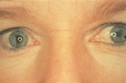 동공이작은쪽에보일수있음 암적응의수준이달라반대편눈에서일시적으로보일수있음 A ganglion) 이나짧은섬모체신경 (short ciliary nerve) 의손상으로발생할수있다. 세극등검사상동공조임근의부분마비로벌레모양의홍채움직임을보일수있고 0.125% 필로카르핀 (pilocarpine) 으로도축동되는동공조임근의콜린과민성을보일수도있다.