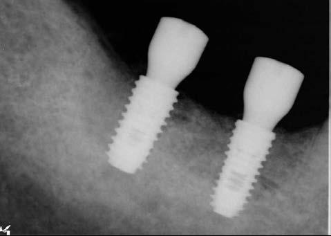 Kim YK: Calcium phosphate dual-coating xenograft 69 Fig. 6. Periapical radiograph 2 weeks after implant placement.