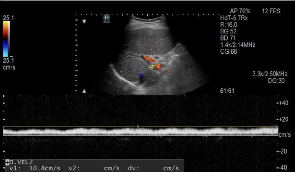 2018 대한간학회추계학술대회 Figure 4. Doppler ultrasonography shows that the portal venous velocity is 10.8 cm/s in a patient with liver cirrhosis.