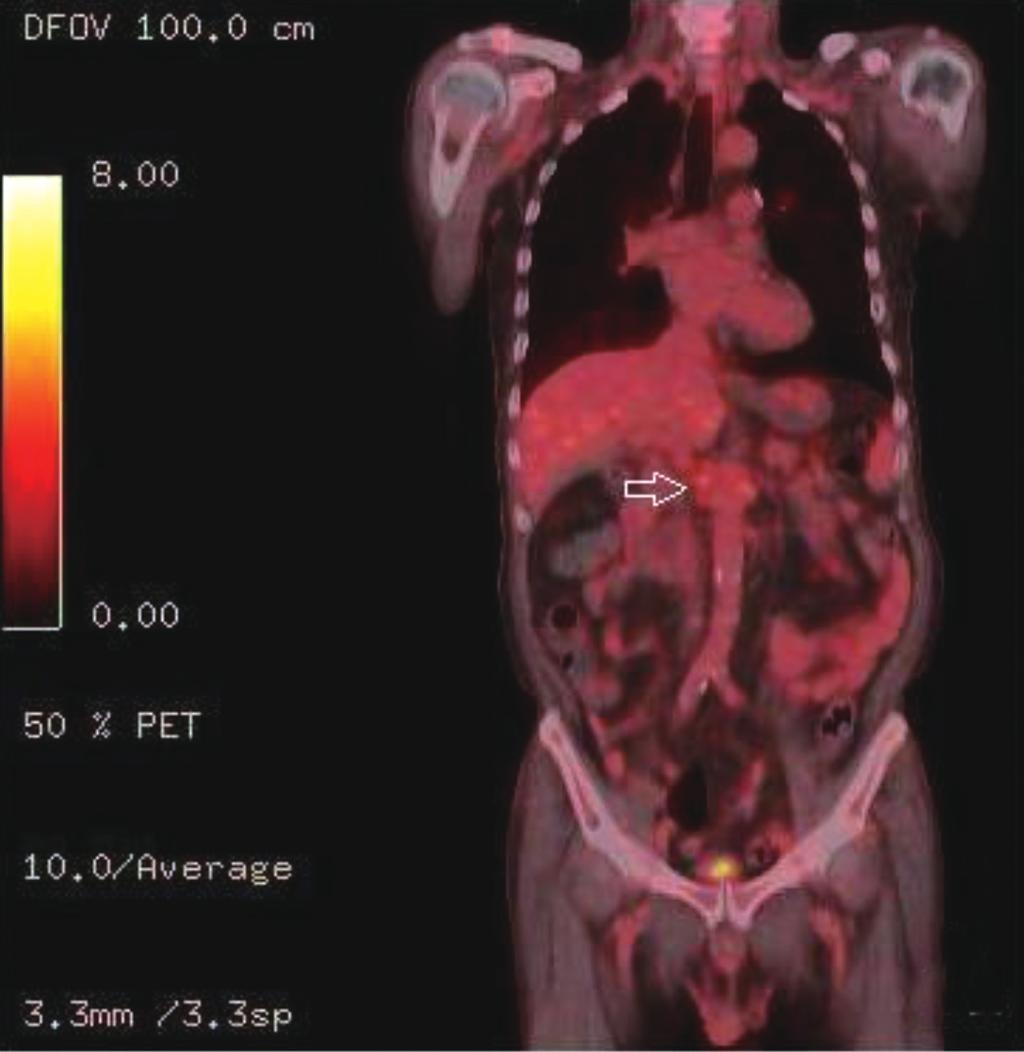 Ho Joon Park, et al. Fig. 6. (, ) n FDG-avid lymph node around the pre-aortic and celiac trunk (arrow) that was suspected malignancy.