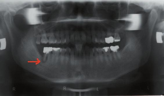 그림 1에서는 SureFuse TM 을처리전 (a) 과후 (b) 에따라서 X-ray 결과가달라짐을알수있다.