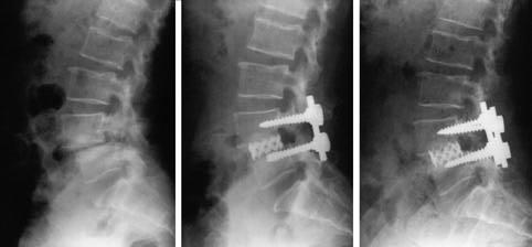 A B C Fig 1-A Lateral radiograph of a 54-year-old woman with spondylolytic spondylolisthesis Fig 1-B Lateral radiograph at the immediate postoperation shows PLIF L4-5 with TPM