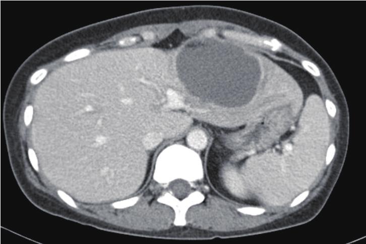 378 KW Hong, et al. Liver Abscess by Aspergillus and E. faecium in an AML Patient 증례 41세여자가내원당일시작된배꼽주위복통과구토가있어서응급실로내원하였다. 환자는내원 45일전급성골수성백혈병을진단받고, 관해유도항암요법 (idarubicin, enocitabine) 을투여받은후 1주전퇴원하였다.