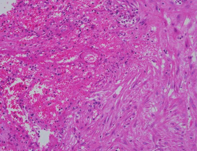 http://dx.doi.org/10.3947/ic.2011.43.4.377 Infect Chemother 2011;43(4):377-381 379 A B Figure 2. Pathologic findings of the liver abscess in case patient.