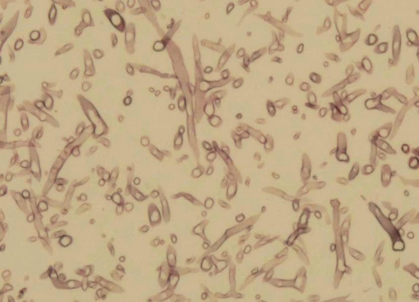 (B) Fungi suspicious of aspergillus species with Y-shaped branching of septated hyphae are scattered within liver abscess (Grocott-Gomori methenamine silver stain, x400). Table 1.