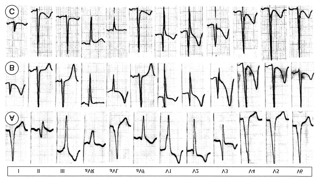 Fig. 5. Serial changes of standard 12-lead electrocardiography in patient who has WPW syndrome with right posterior accessory pathway.