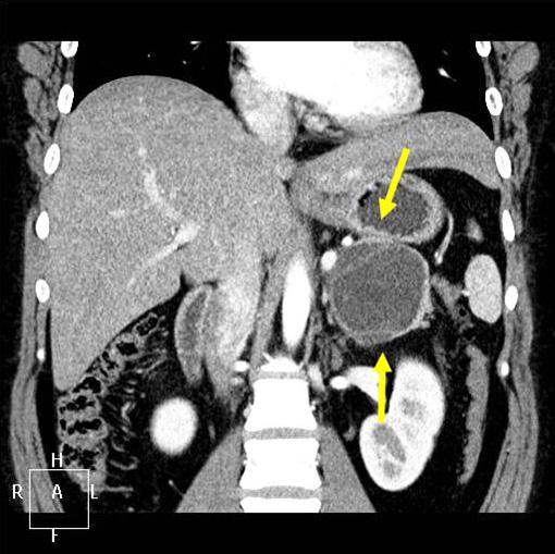 pancreas tail (coronal reformatted image, arrow). A B B Figure 3.