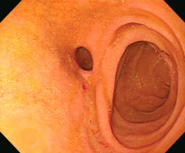 Figure 3. Endoscopic findings. (A, B) Endoscopy shows no remnant stone in the anastomotic area of choledochoduodenostomy and bile ducts. (C) It shows a dilated papilla after balloon dilation.