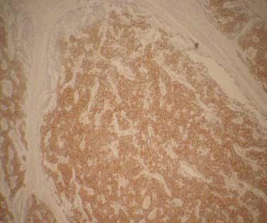 Abdominal CT shows submucosal tumor at pylorus