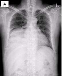 A CT scan shows a huge mass (14 12 11 cm) in the right lower lobe