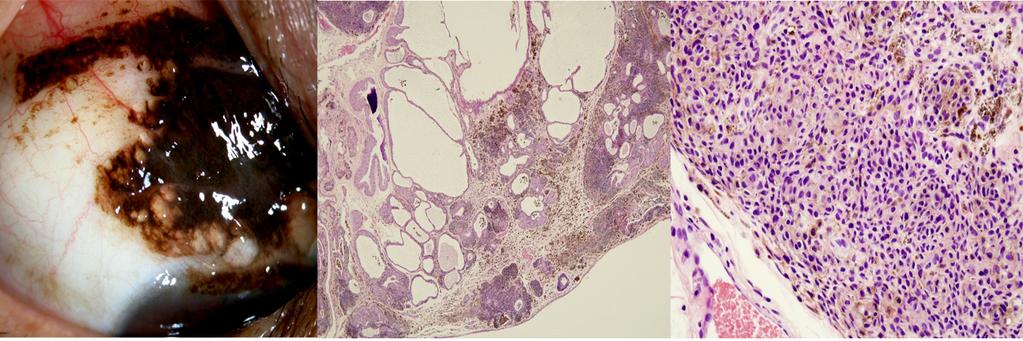 Melanocyte formed a nest shape. Tissue shows several stromal cysts and neurotinization (cell size is getting smaller near the dermis).