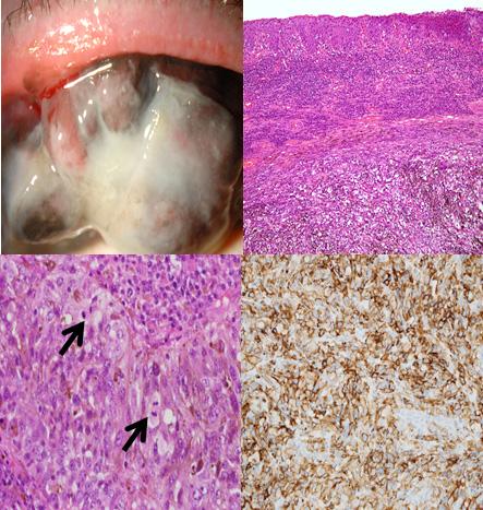 - 장수경외 : 결막표면종양 - A B C D Figure 4. Slit-lamp photograph and Histologic features of Malignant melanoma. (A) Slit-lamp photograph shows pigmented conjunctival mass at superior palpebral conjunctiva.