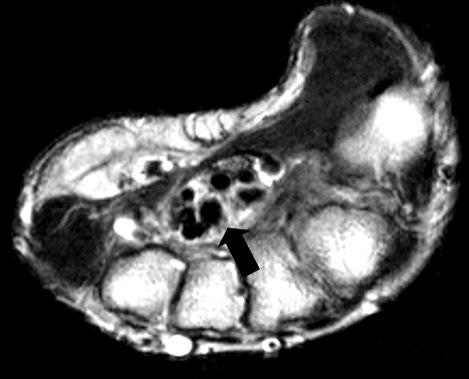 (A) MRI shows tophi infiltration between flexor digitorum profundus tenosynovium and carpal bones (white