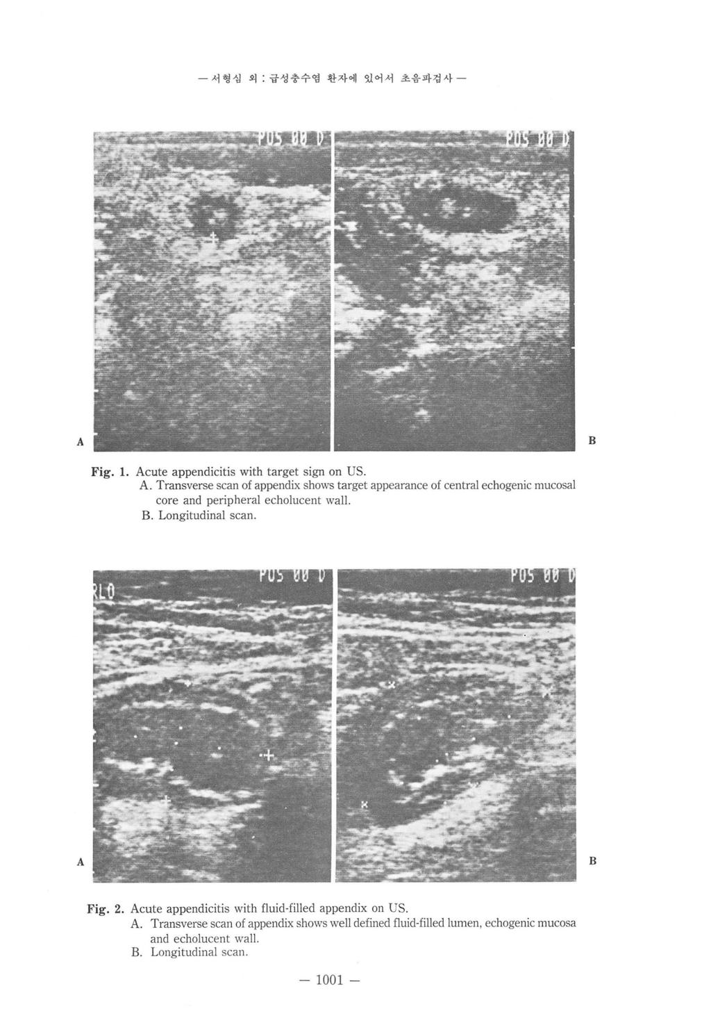 - 서형성외 급성충수영환자에있어서초음파검사 - Fig. 1. cute appendicitis with target sign on US Transverse scan of appendix shows target appearance of central echogenic mucosal core and peripheral echolucent wall.