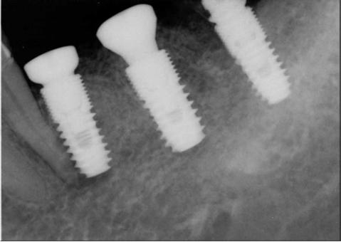 Ku JK, et al: The clinical prognosis of implants invading the adjacent natural tooth and invaded teeth 13 립하면서주변치아들을침범할위험이항상존재한다.