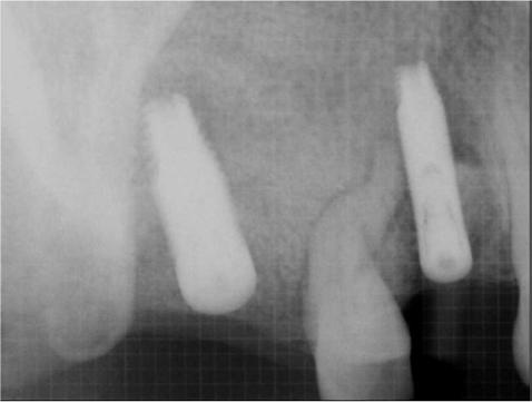 Ku JK, et al: The clinical prognosis of implants invading the adjacent natural tooth and invaded teeth 15 Table 4.