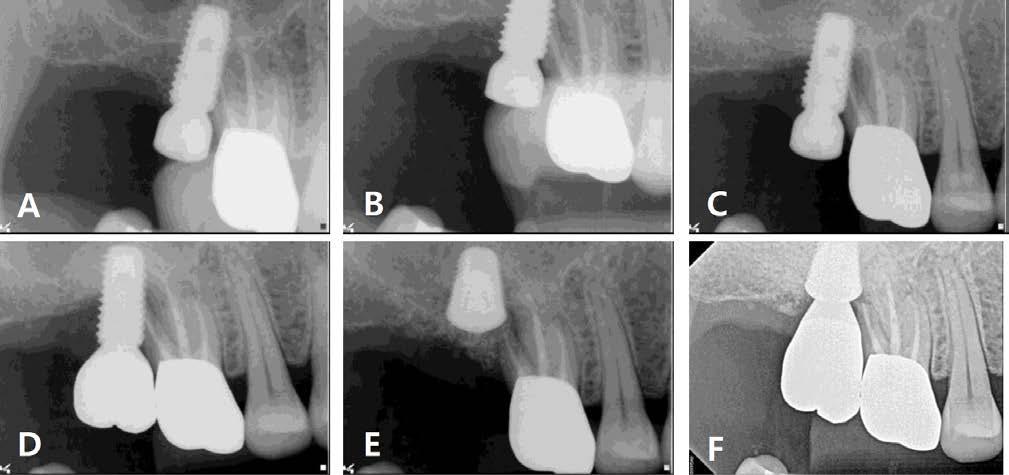 Ku JK, et al: The clinical prognosis of implants invading the adjacent natural tooth and invaded teeth 17 Fig. 7. (A) Periapical radiograph after implant placement.