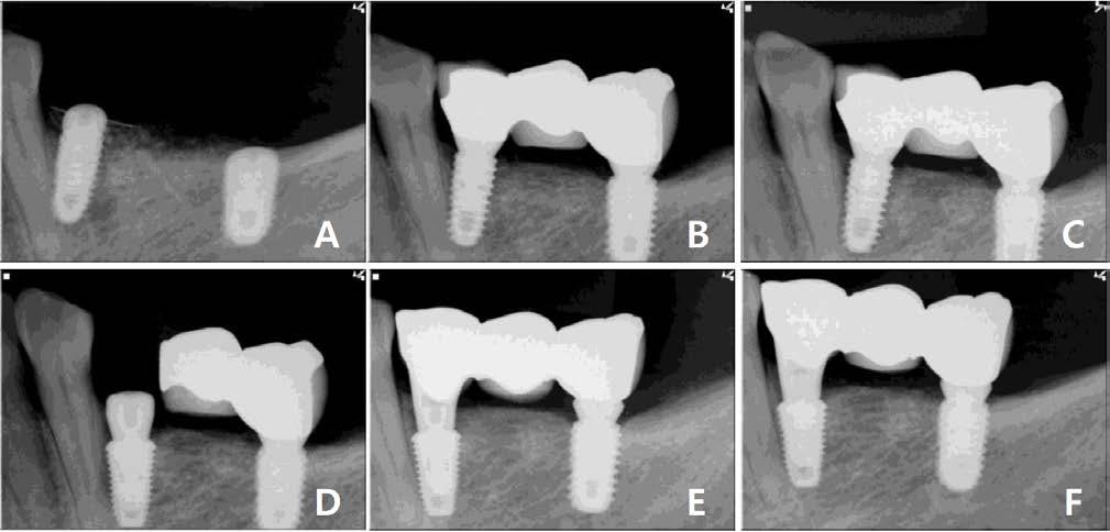 Marginal bone was lost around the implant. (D) Implant was mobile and removed 6 months after implant placement. (E) Ultrawide implant was re-installed with bone graft.