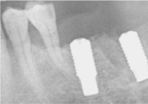 교정용미니스크류 Fig. 9. Root canal treatment was performed in the invaded natural tooth. Fig. 10. The curved root apex of the 2 nd premolar was contacted with the implant.
