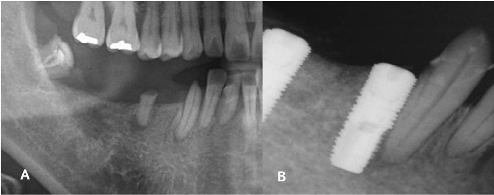 Clinical prognosis of the natural teeth and implants which implants invaded the adjacent tooth directly (Group I) Implant Number (12) Nature tooth Number (12) Survival 10 83.