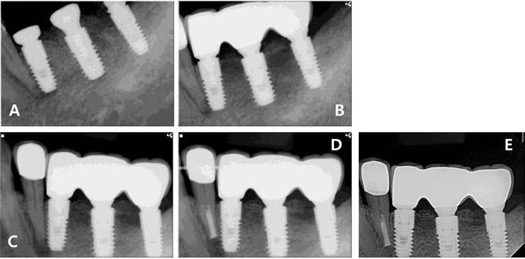 Ku JK, et al: The clinical prognosis of implants invading the adjacent natural tooth and invaded teeth 19 Table 7.