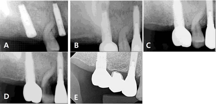 92% Failure 0 0.00% RCT after implantation 3 23.08% Extraction after implantation 0 0.00% Fig. 12. (A) Periapical radiograph after implant placement.