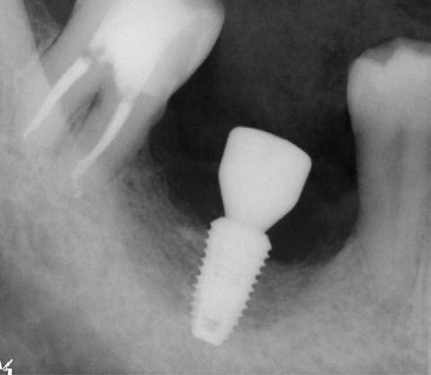 Implant was exposed 3 month after 1 st Second stability was measured as 85 ISQ.