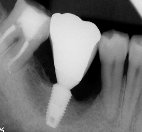 Ku JK, et al: The retrospective clinical study of the autogenous tooth block bone graft 31 Fig. 12. Periapical radiograph 12 months after prosthetic loading. Fig. 14.