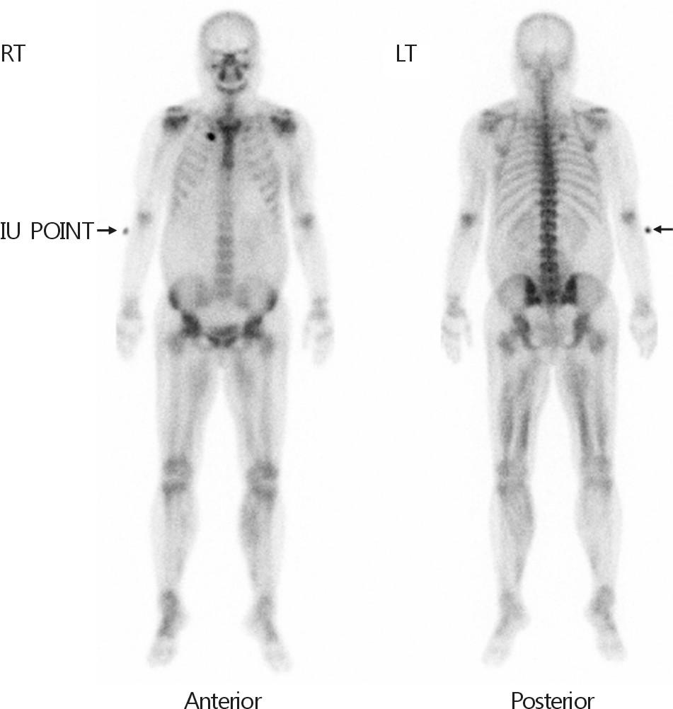 Osmotic Demyelination Syndrome in a Patient with Severe Hyponatremia Complicated by Rhabdomyolysis Fig. 1.