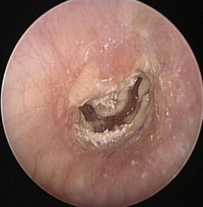 Fungal Chronic Otitis Media with Facial Nerve Palsy Chung DY, et al. Fig. 1.