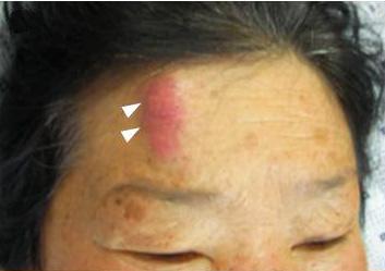 - Young Jae Ki, et al. Sweet s syndrome with arthritis - 증례보고한다.